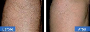 Laser hair removal client result