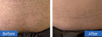 Laser treatment result