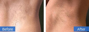 Laser hair removal before and after