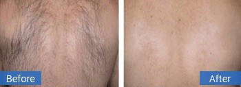 Back hair removal before treatment