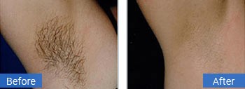 Laser Hair Removal Fort Lauderdale FL | Palm Beach Laser & Aesthetic