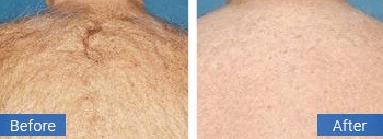 Back hair removal result
