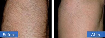 How Permanent is Laser Hair Removal  Fort Lauderdale Laser Hair Removal   Baltic Beauty Centre